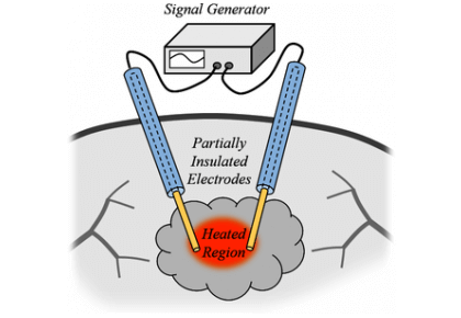 شبیه‌سازی فرسایش بافتی RF-کامسول