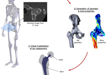 استرس و خستگی در ایمپلنت های مدولار مورد استفاده در مفاصل ران