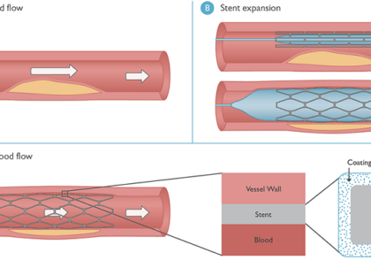 آشنایی با استنت های دارویی در بوستون ساینتیفیک