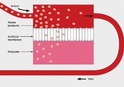 بهینه سازی طراحی دیالایزر با استفاده از شبیه سازی چندفیزیکی